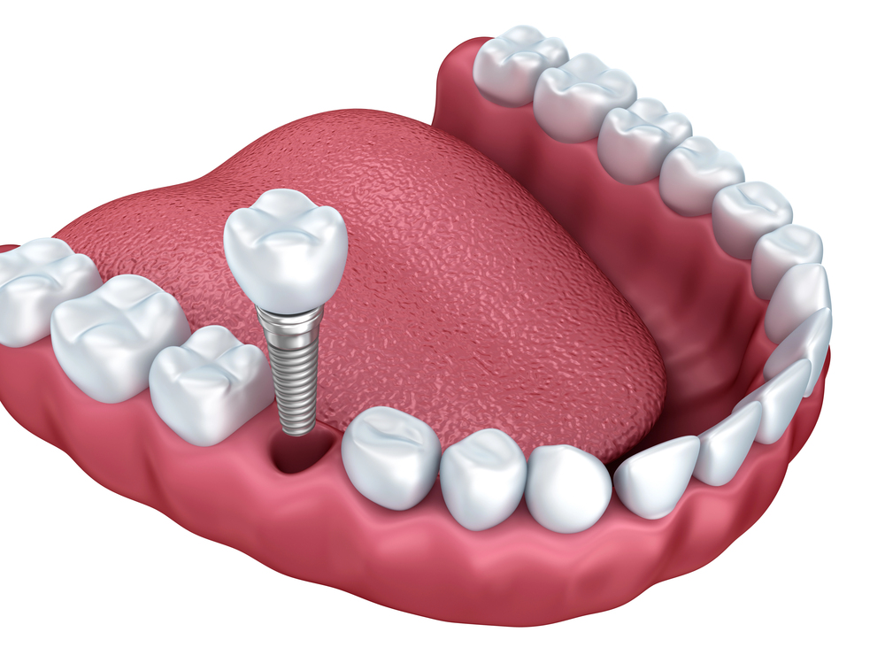 All-on-X Dental Implants